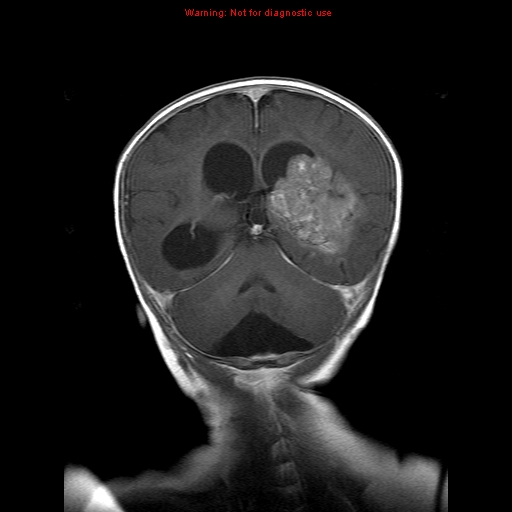 File:Atypical teratoid rhabdoid tumor (Radiopaedia 10712-11183 Coronal T1 C+ 7).jpg