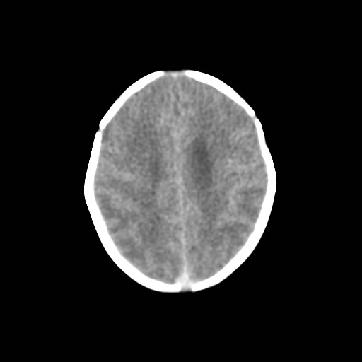 File:Atypical teratoid rhabdoid tumor (prenatal US and neonatal MRI) (Radiopaedia 59091-66387 Axial non-contrast 30).jpg