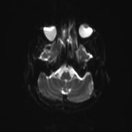 Autoimmune limbic encephalitis (Radiopaedia 30363-31005 Axial B0 and DWI 8).jpg