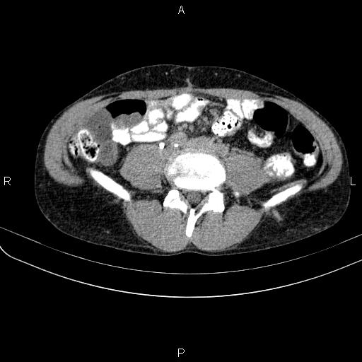Autoimmune pancreatitis (Radiopaedia 84925-100431 Axial C+ delayed 55).jpg