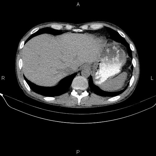 Autoimmune pancreatitis (Radiopaedia 84925-100431 Axial non-contrast 9).jpg