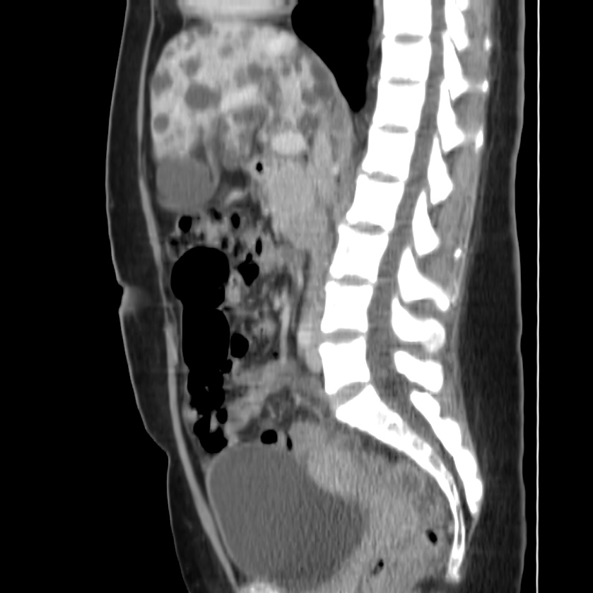 Autosomal dominant polycystic kidney disease (Radiopaedia 23061-23093 F 27).jpg