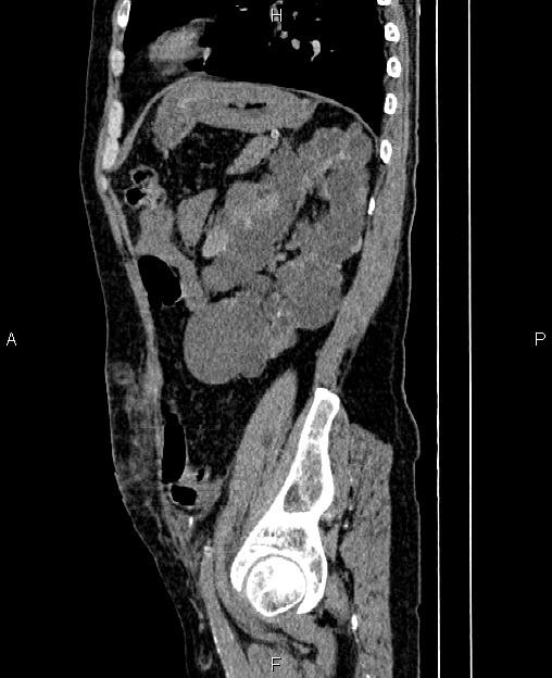Autosomal dominant polycystic kidney disease (Radiopaedia 87830-104287 C 69).jpg