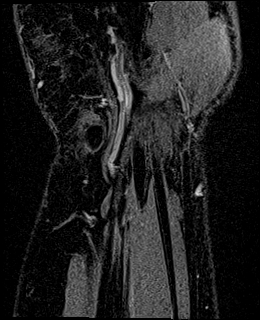 Avascular necrosis of the capitate (Radiopaedia 88317-104948 Coronal T1 vibe 80).jpg