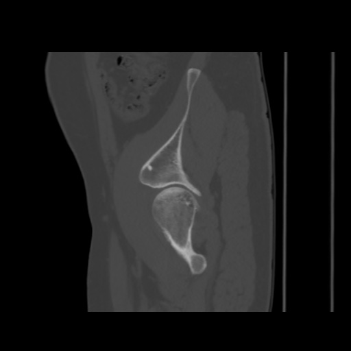 Avascular necrosis of the hip (Radiopaedia 61503-69467 B 12).jpg