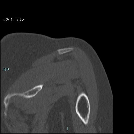 Avascular necrosis of the shoulder - Cruess stage I (Radiopaedia 77674-89887 Coronal bone window 75).jpg