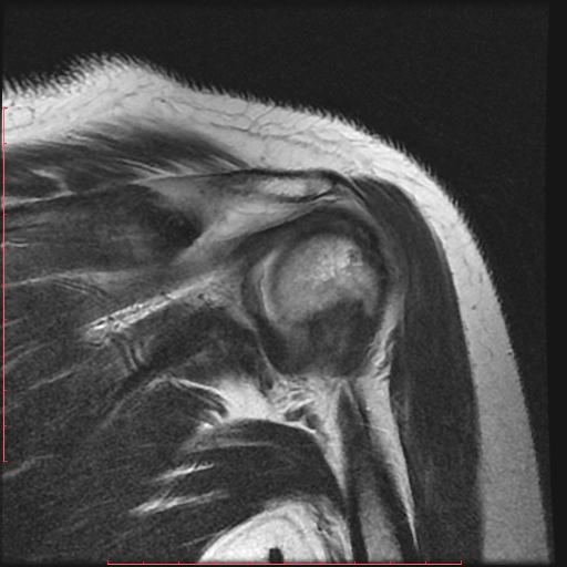 File:Avulsion fracture - greater tuberosity of humerus (Radiopaedia 25457-25703 Coronal T2 10).jpg