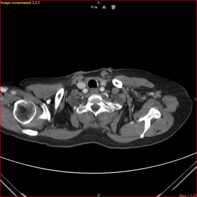 Azygos vein aneurysm (Radiopaedia 77824-90130 B 5).jpg