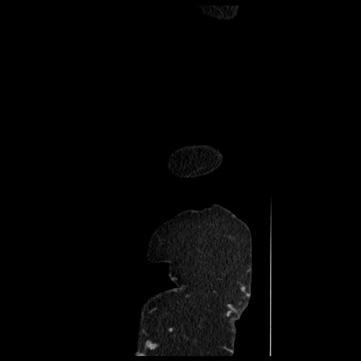 B-cell lymphoma of the mesentery (Radiopaedia 65711-74827 C 13).jpg