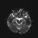 Balo concentric sclerosis (Radiopaedia 50458-55940 Axial DWI 14).jpg
