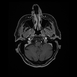 Balo concentric sclerosis (Radiopaedia 53875-59982 Axial LAVA C+ 51).jpg