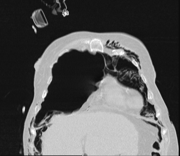 Barotrauma due to mechanical ventilation (Radiopaedia 28079-28336 Coronal lung window 22).jpg