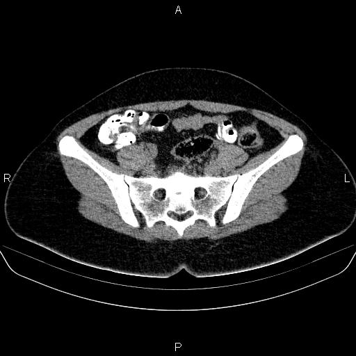 Bartholin gland cyst (Radiopaedia 62635-70930 Axial non-contrast 25).jpg