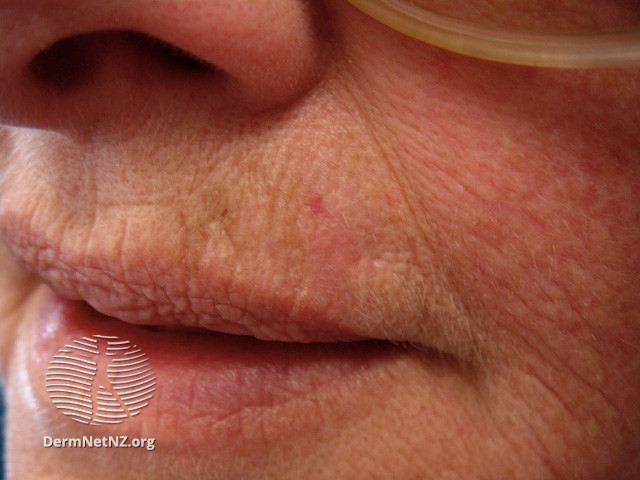 Basal cell carcinoma affecting the face (DermNet NZ lesions-bcc-face-0811).jpg
