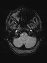 Base of skull chondrosarcoma (Radiopaedia 30410-31070 Axial SWI 8).jpg