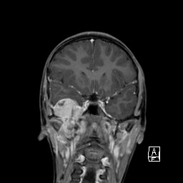 Base of skull rhabdomyosarcoma (Radiopaedia 32196-33142 I 32).jpg