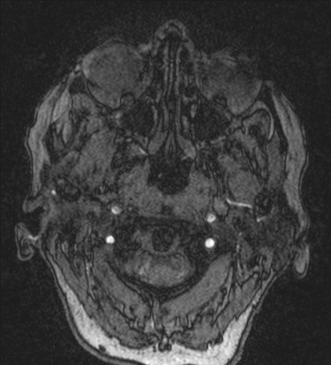 Basilar tip aneurysm (Radiopaedia 26504-26632 MRA 1).jpg