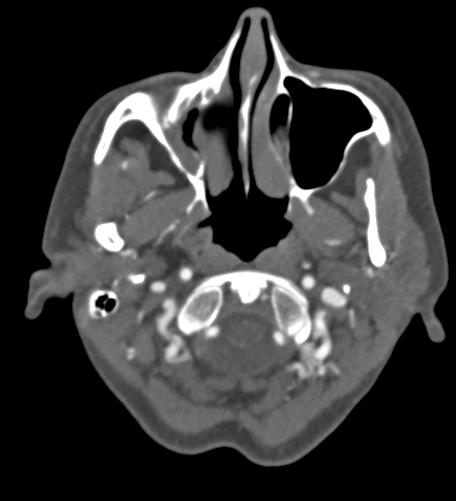 File:Basilar tip aneurysm with coiling (Radiopaedia 53912-60086 A 14).jpg