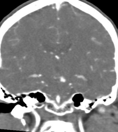 Basilar tip aneurysm with coiling (Radiopaedia 53912-60086 B 80).jpg