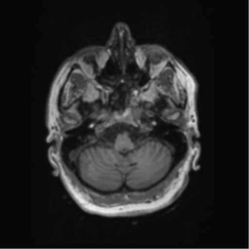 Behavioral variant frontotemporal dementia and late onset schizophrenia (Radiopaedia 52197-58083 Axial T1 92).png