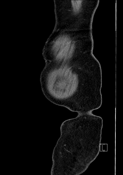 Benign colonic stricture with colo-colonic fistula (Radiopaedia 59439-66800 C 5).jpg