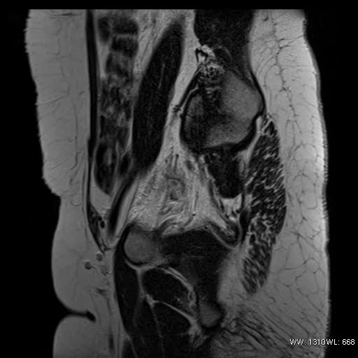 File:Bicornuate uterus- on MRI (Radiopaedia 49206-54297 Sagittal T2 3).jpg