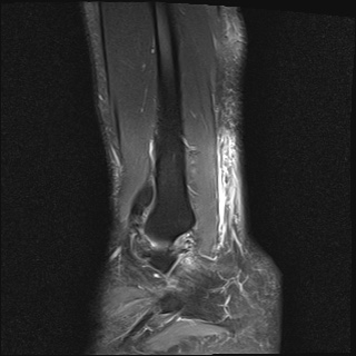 File:Bilateral Achilles tendon complete tear (Radiopaedia 81344-95051 Sagittal T2 fat sat 3).jpg