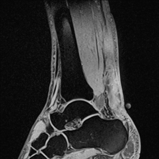 File:Bilateral Achilles tendon complete tear (Radiopaedia 81344-95051 Sagittal WE - Right 54).jpg
