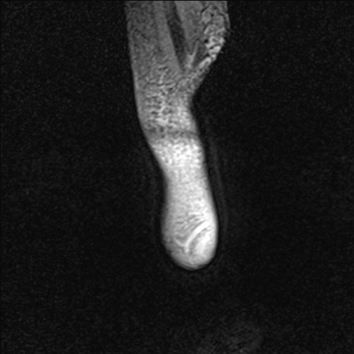 Bilateral Achilles tendon complete tear (Radiopaedia 81344-95051 Sagittal WE - Right 7).jpg