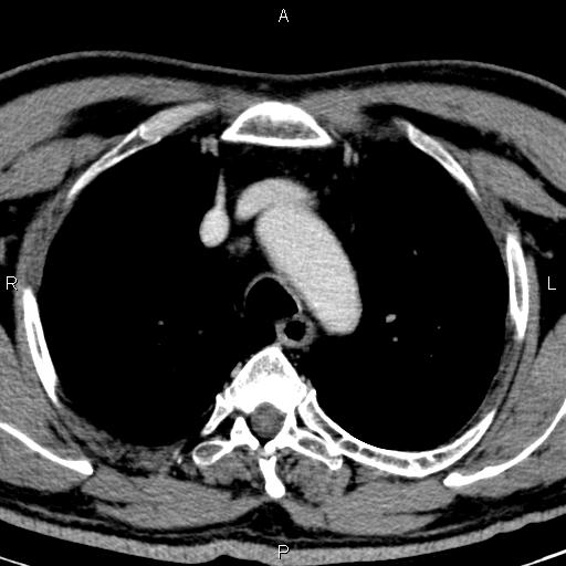 File:Bilateral Warthin tumors (Radiopaedia 84034-99263 Axial With contrast 77).jpg