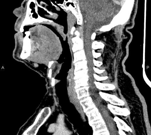 Bilateral Warthin tumors (Radiopaedia 84034-99263 D 40).jpg