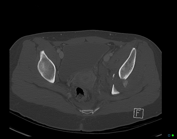 Bilateral acetabular fractures (Radiopaedia 79272-92308 Axial bone window 38).jpg