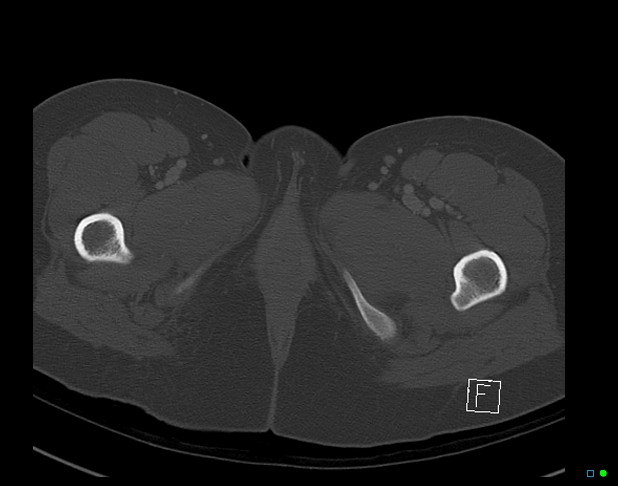Bilateral acetabular fractures (Radiopaedia 79272-92308 Axial bone window 66).jpg