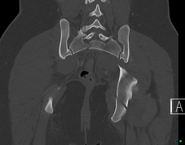 File:Bilateral acetabular fractures (Radiopaedia 79272-92308 Coronal bone window 32).jpg
