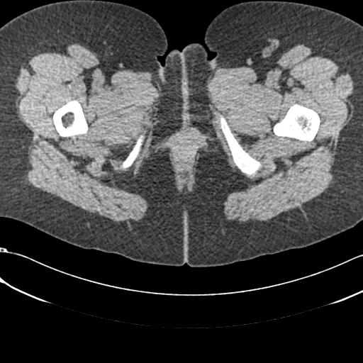 Bilateral acetabular protrusion with pincer type femoro-acetabular impingement (Radiopaedia 30134-30733 AXIAL SOFT THIN 112).jpg