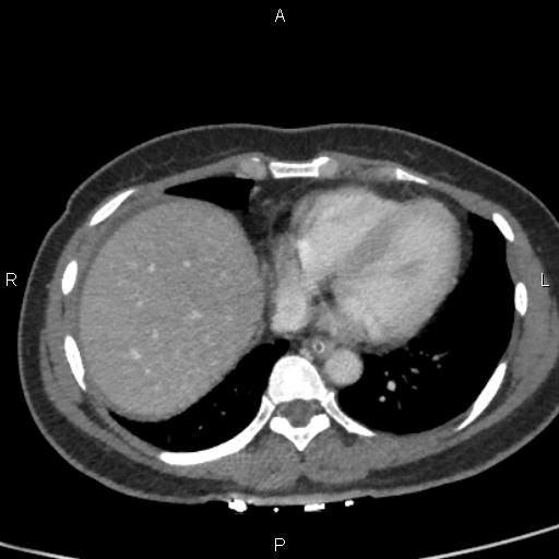 Bilateral adrenal gland hyperenhancement in pancreatitis (Radiopaedia 86642-102753 E 5).jpg