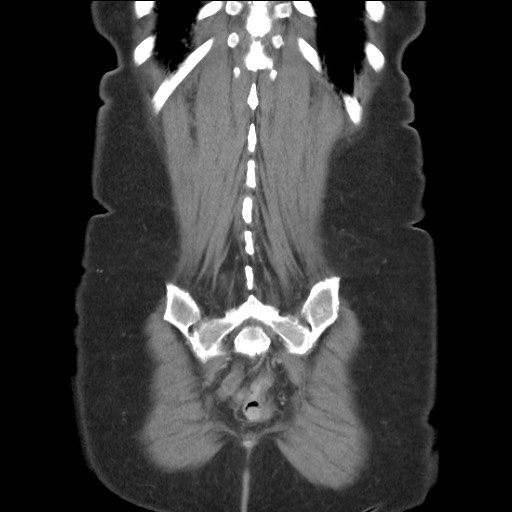 Bilateral adrenal granulocytic sarcomas (chloromas) (Radiopaedia 78375-91007 B 80).jpg