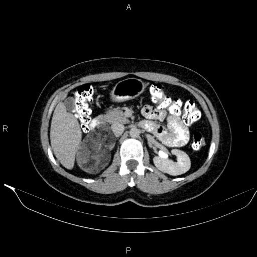 Bilateral adrenal myelolipoma (Radiopaedia 63058-71535 Axial C+ delayed 42).jpg