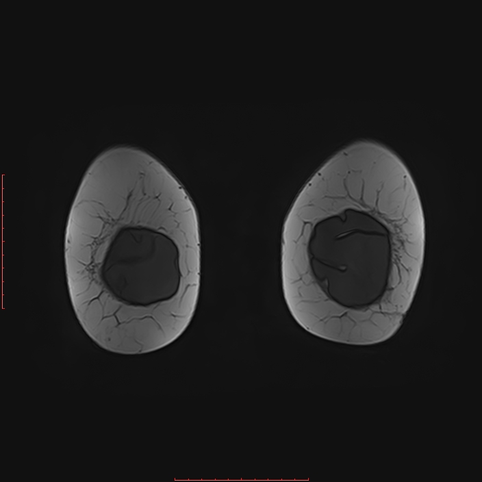 Bilateral breast implant rupture (Radiopaedia 24761-25027 G 103).jpg