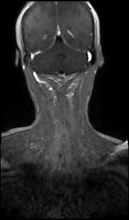 File:Bilateral carotid body tumors and right glomus jugulare tumor (Radiopaedia 20024-20060 MRA 63).jpg