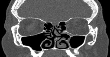 File:Bilateral ectopic infraorbital nerves (Radiopaedia 49006-54084 Coronal 36).png