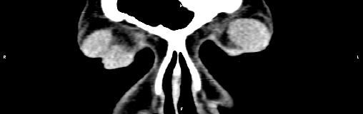 File:Bilateral enlargement of lacrimal glands - sarcoidosis (Radiopaedia 62627-70921 Coronal non-contrast 5).jpg