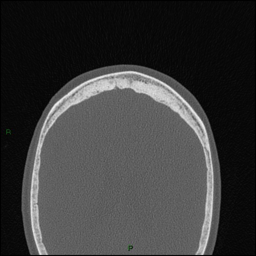 File:Bilateral frontal mucoceles (Radiopaedia 82352-96454 Axial bone window 30).jpg