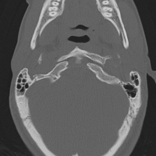 Bilateral locked facets (Radiopaedia 33850-35016 Axial bone window 3).png