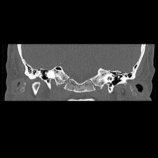 File:Bilateral ossifications of the external auditory canal (Radiopaedia 15233-15076 Coronal bone window 7).jpg