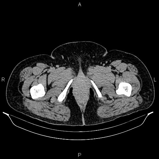 Bilateral ovarian dermoid cysts (Radiopaedia 85785-101603 Axial C+ delayed 96).jpg