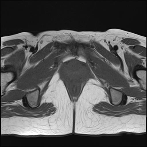 File:Bilateral ovarian endometriomas (Radiopaedia 87085-103347 Axial T1 21).jpg