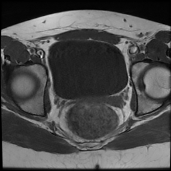 File:Bilateral ovarian fibrothecomas - adolescent (Radiopaedia 86604-102707 Axial T1 21).jpg