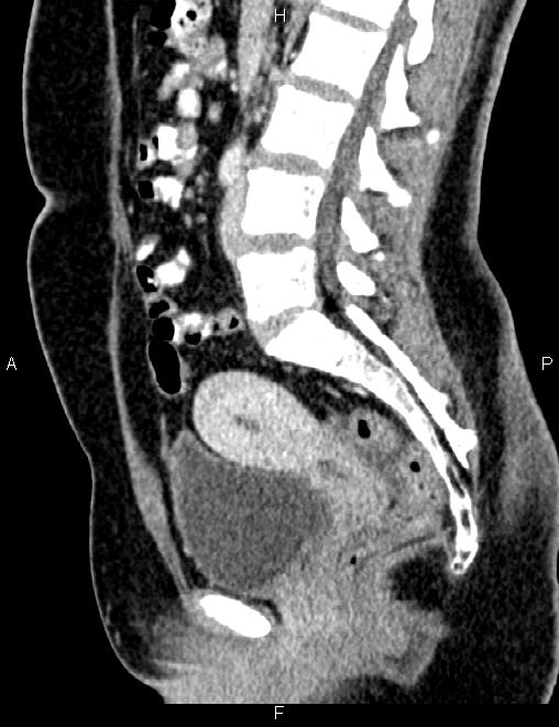 Bilateral ovarian teratoma (Radiopaedia 83131-97503 D 61).jpg