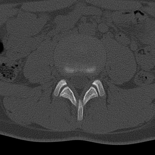 Bilateral pars defect (Radiopaedia 26691-26846 Axial bone window 17).jpg